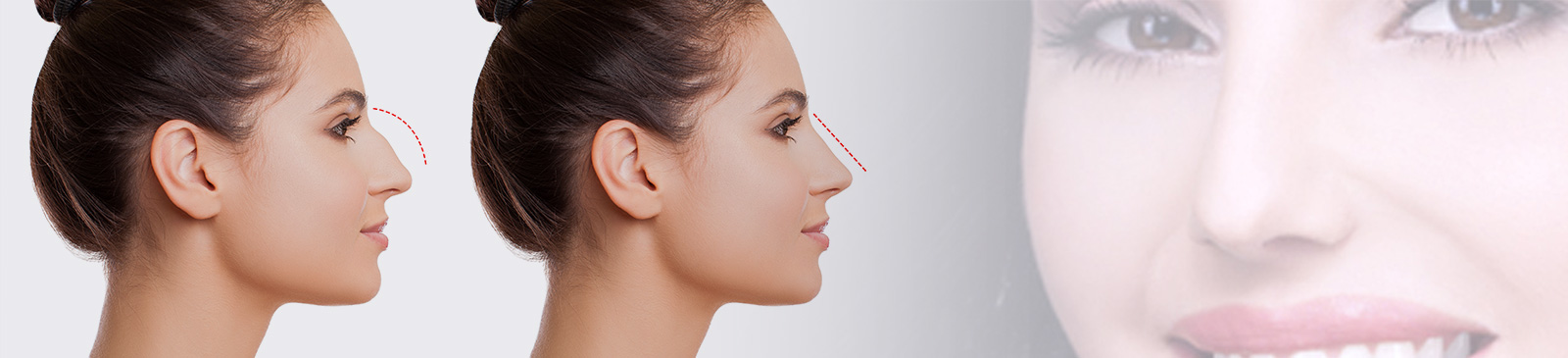 nose operation in bangalore