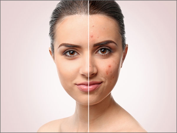 Acne scar removal Bangalore