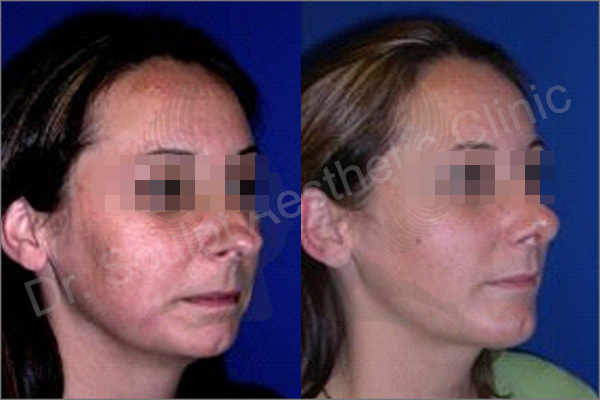 Before and After image of Rhinoplasty treatment at Dr.sculpt clinic Bangalore