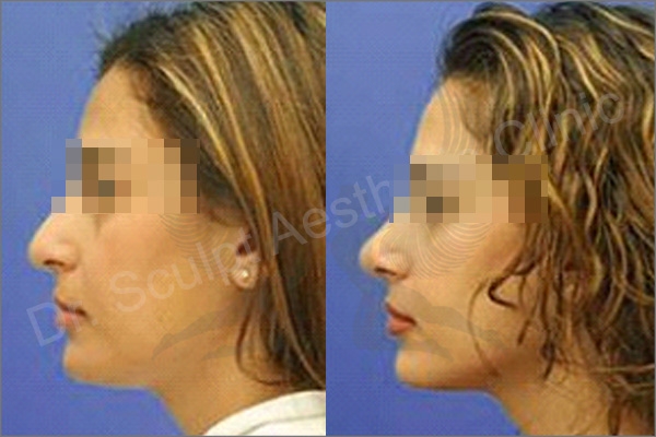 Rhinoplasty treatment at Dr.Sculpt Bangalore Before and After