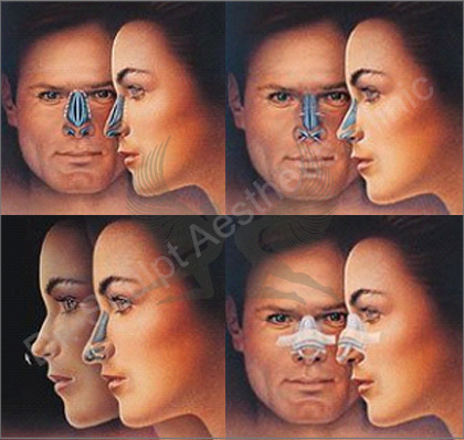 rhinoplasty surgery in Bangalore